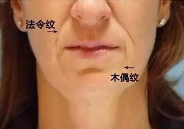 什么是木偶纹