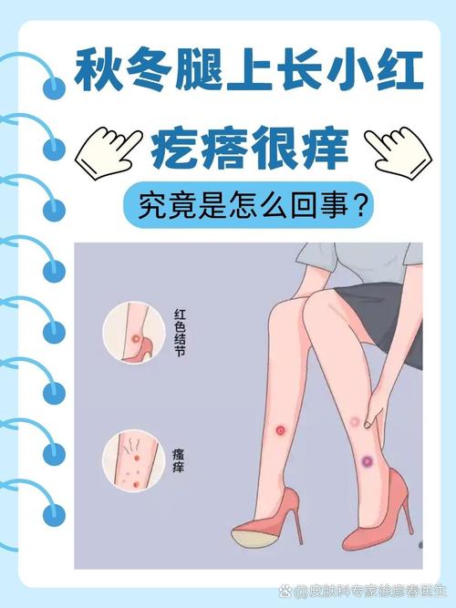 冬天腿痒是什么原因