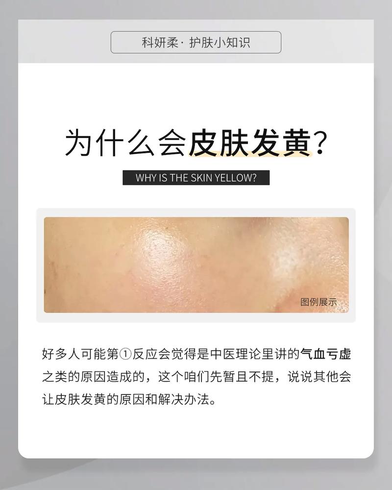 皮肤泛黄是什么原因
