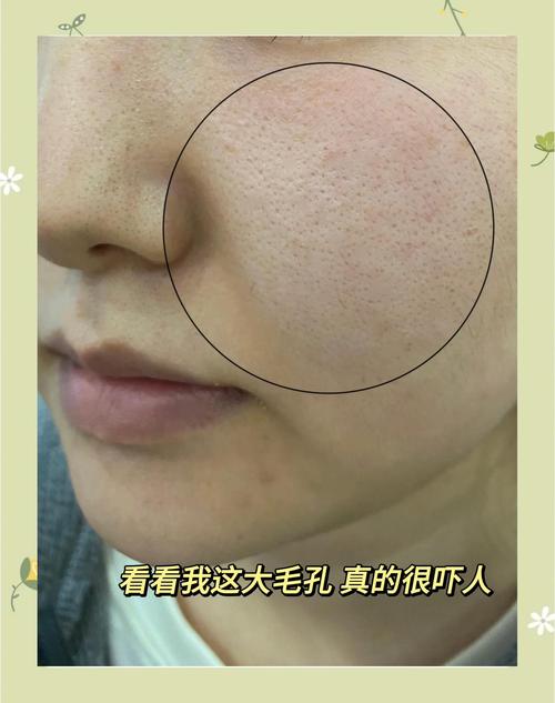 用什么可以缩小毛孔
