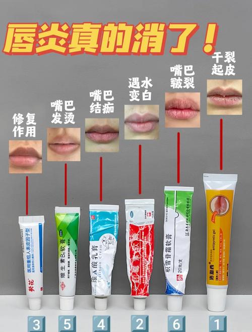 嘴唇干裂脱皮用什么药