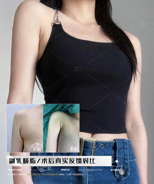 副乳什么样的