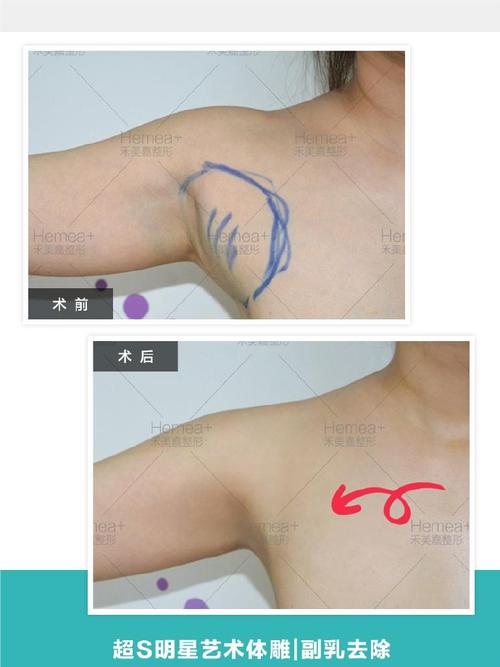 副乳什么样的