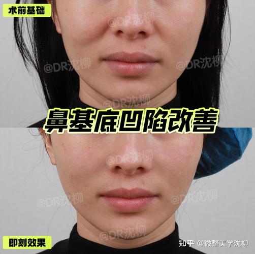 为什么鼻基底会凹陷