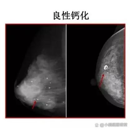 脂肪钙化是什么意思