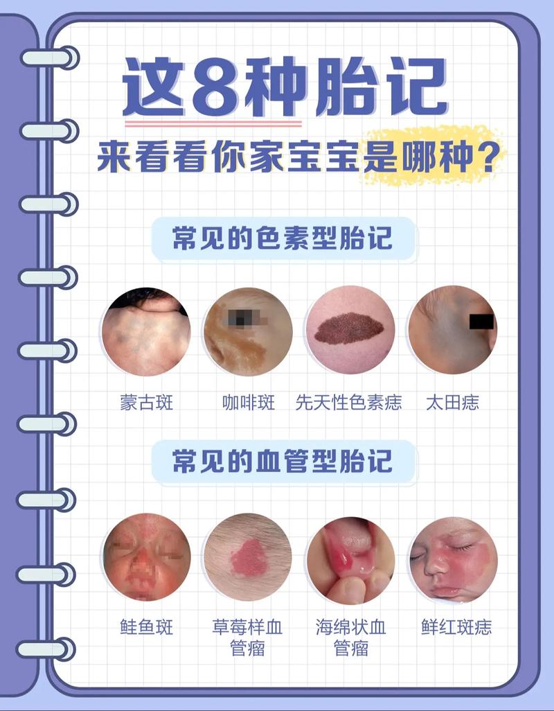 宝宝为什么会长胎记