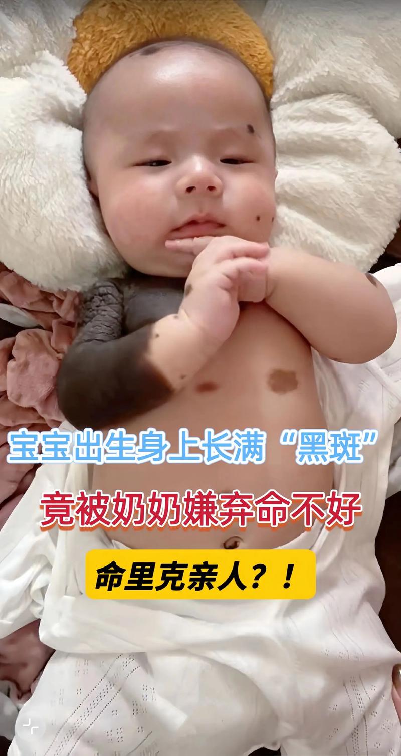 宝宝为什么会长胎记