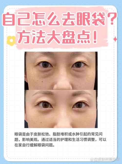 什么方法可以去眼袋