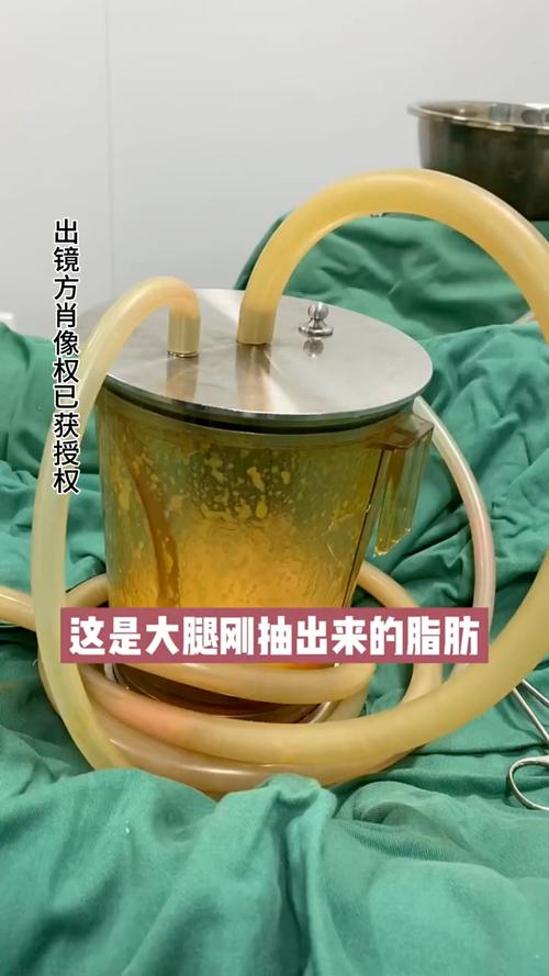 抽脂什么样