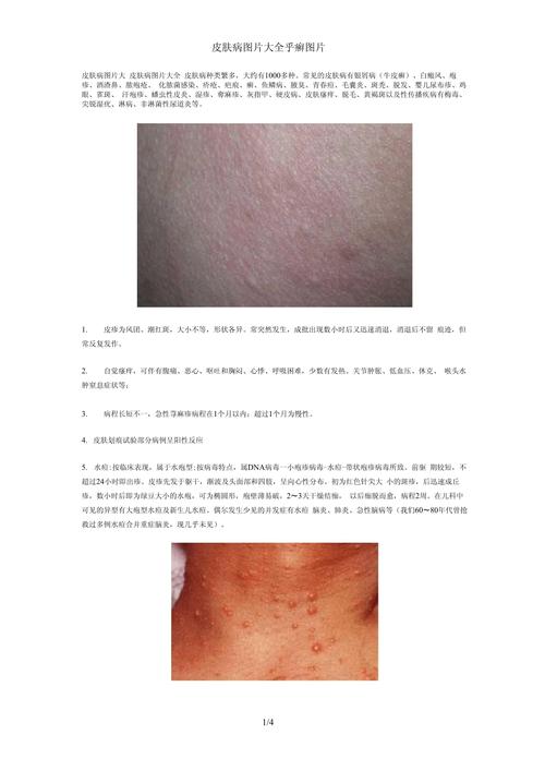 什么是癣病
