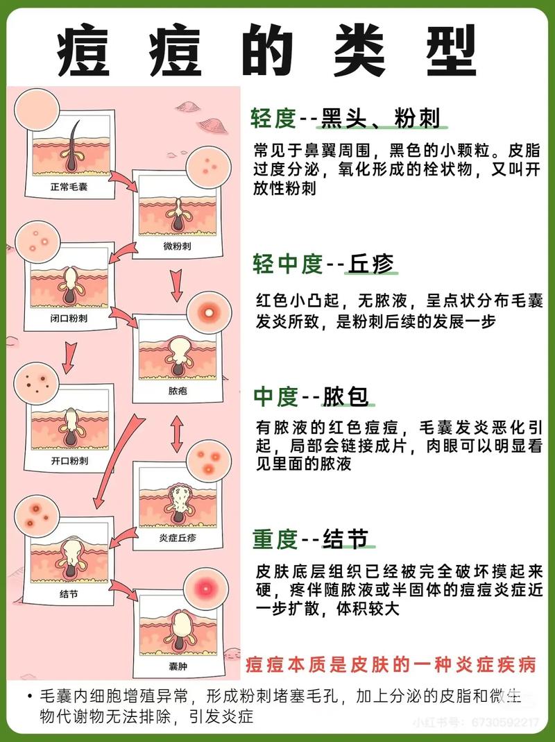 为什么有痤疮