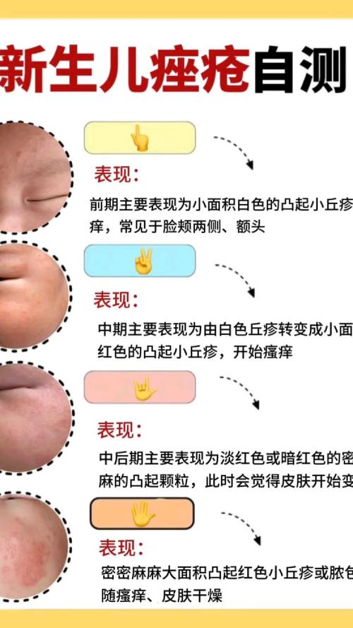 为什么有痤疮