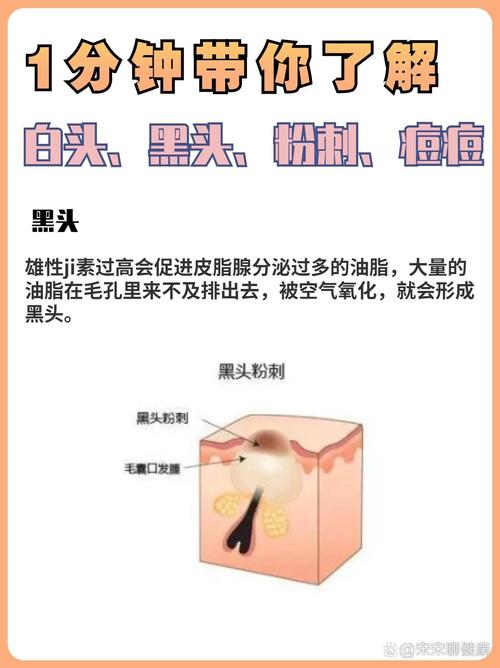 为什么会长白头粉刺