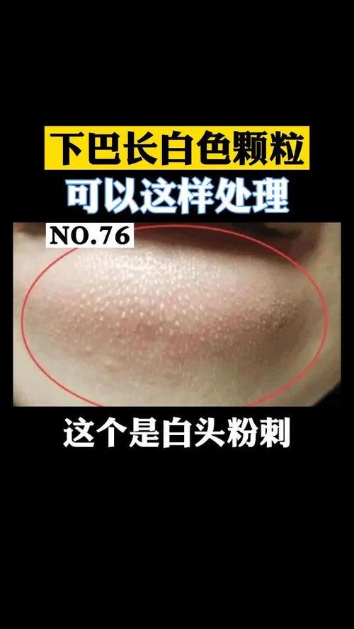为什么会长白头粉刺