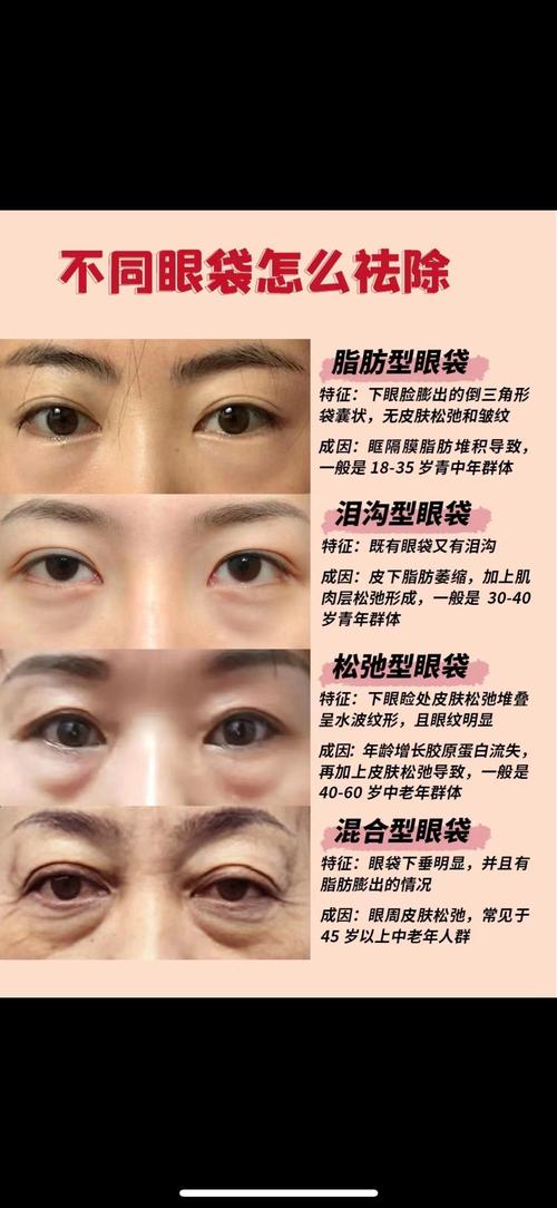 去眼袋有什么好方法
