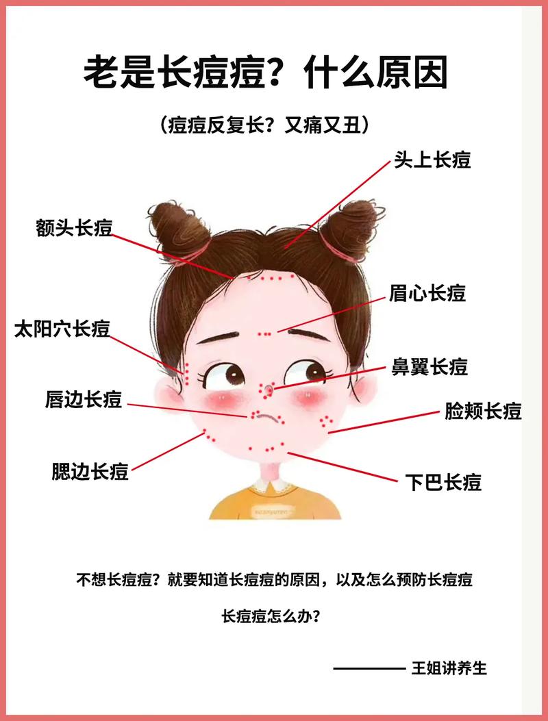 什么皮肤容易长痘