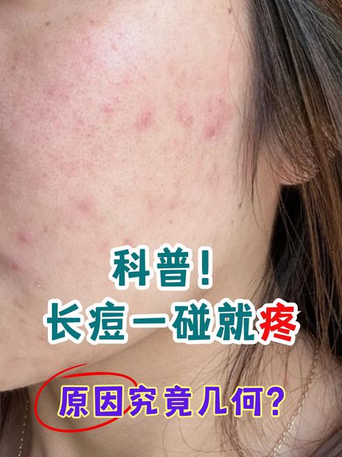 什么皮肤容易长痘
