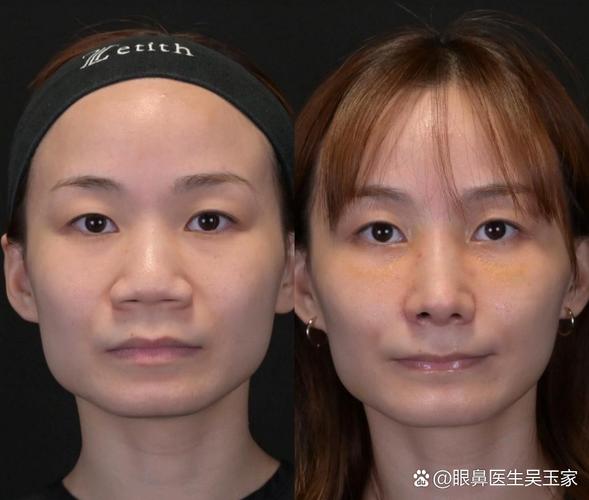 鼻子为什么变大了