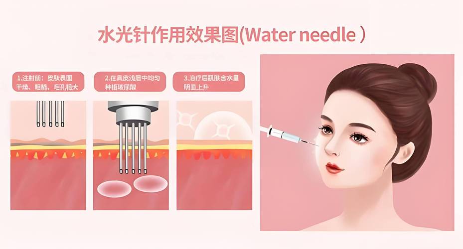 基础水光针是什么