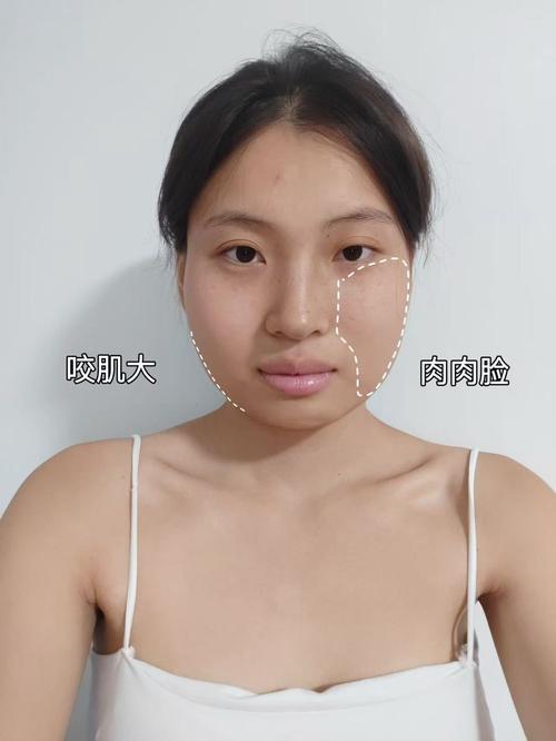v脸针是什么