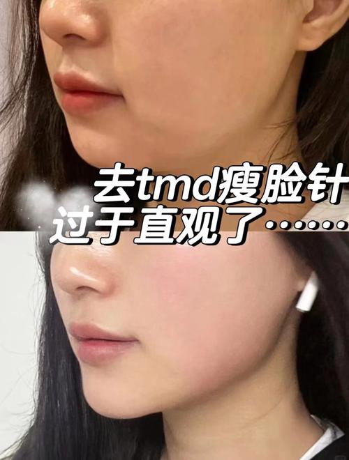 v脸针是什么