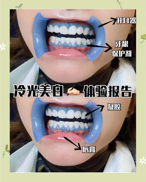 什么是冷光美白