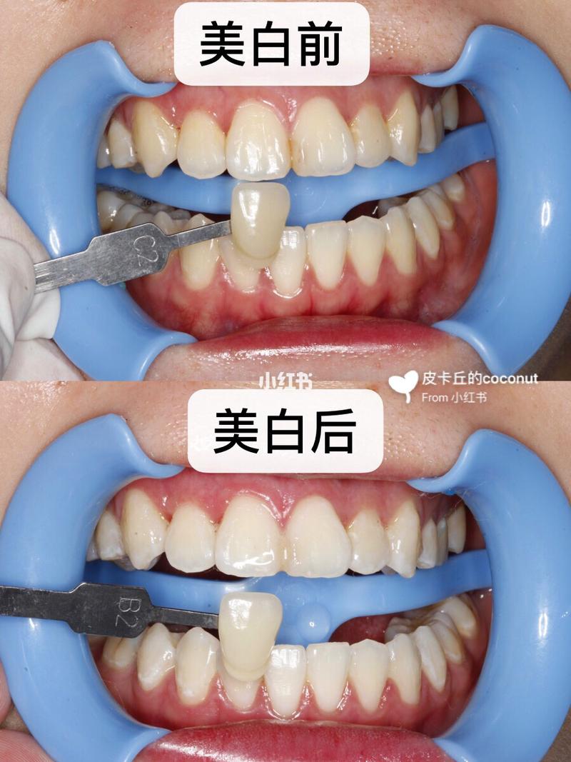 什么是冷光美白