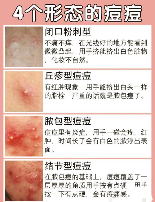 皮肤为什么会长粉刺