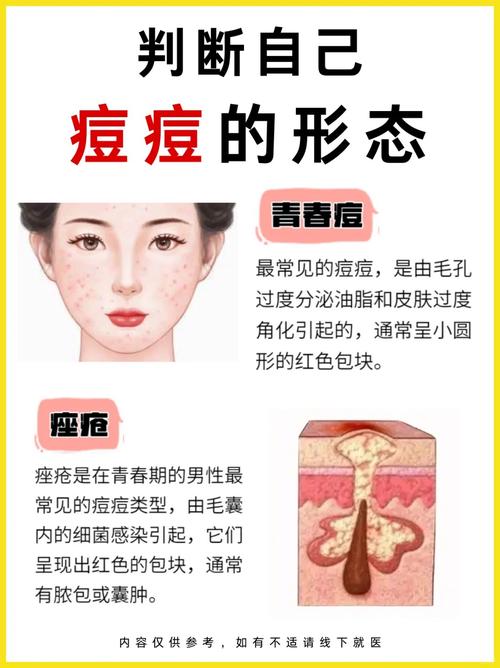 皮肤为什么会长粉刺