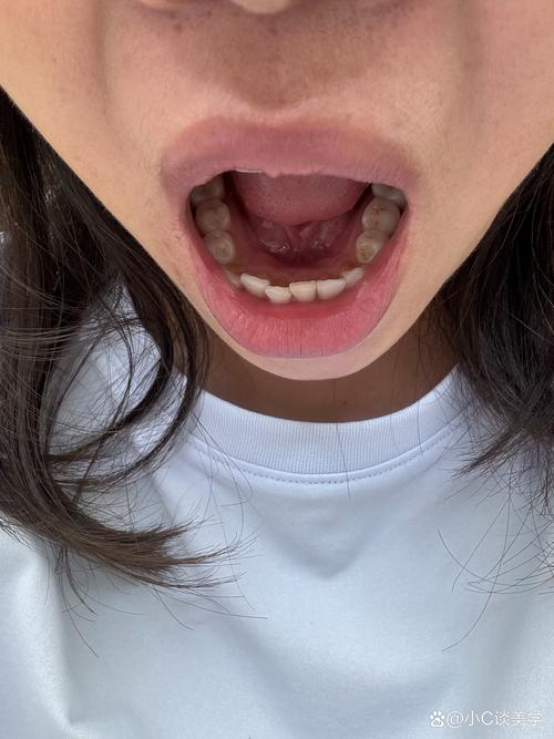 什么是滴牙