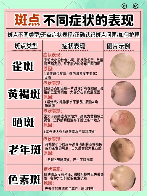 为什么脸上长黄褐斑
