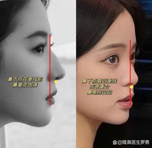 鼻基底为什么会凹陷