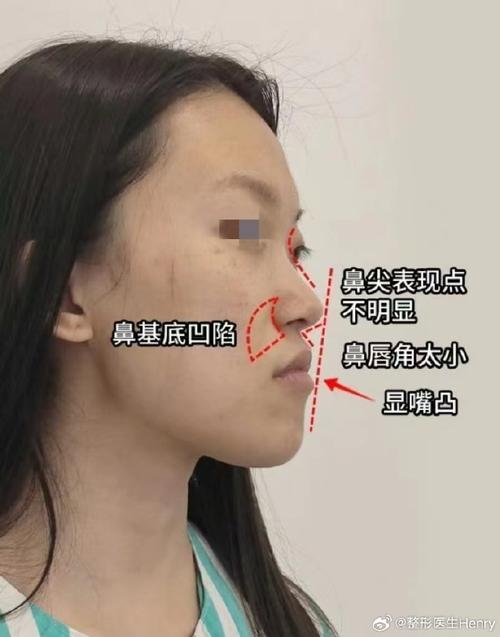 鼻基底为什么会凹陷