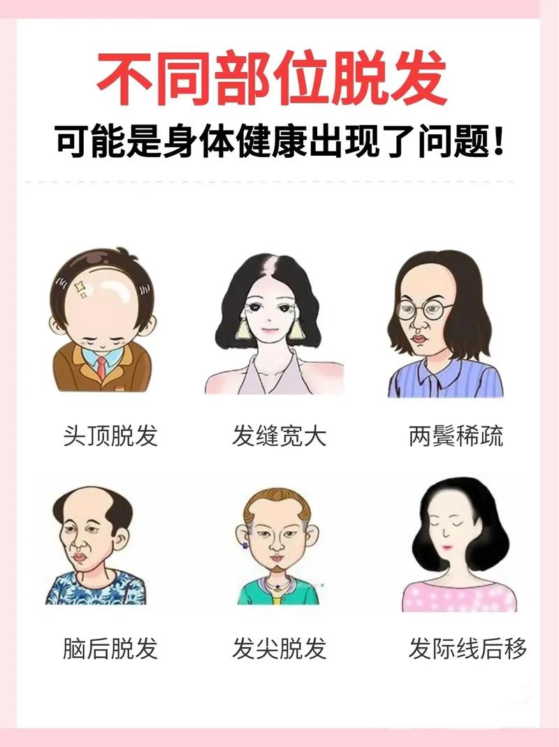 年轻人为什么脱发