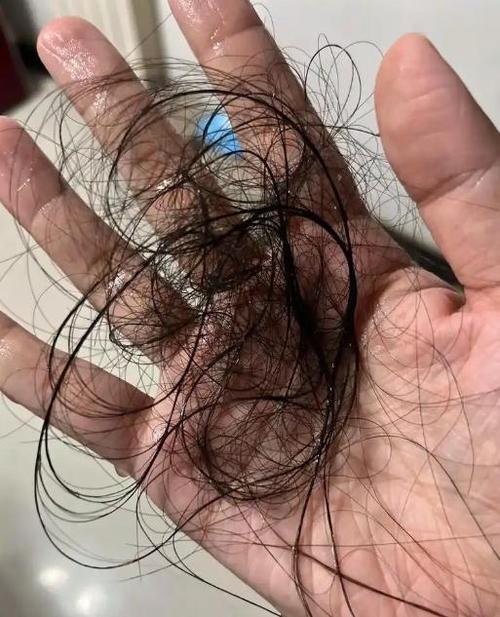 年轻人为什么脱发