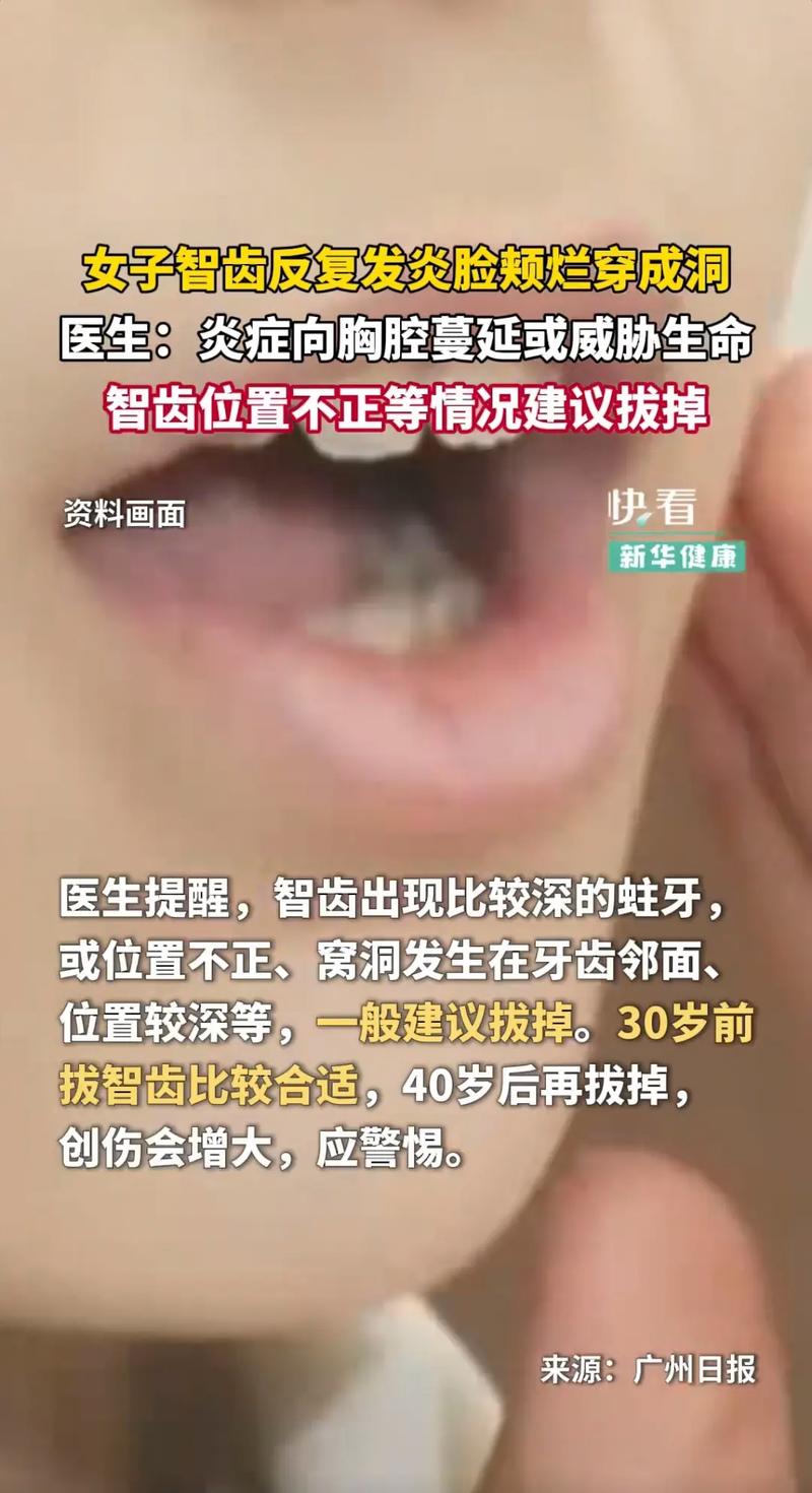 长智齿为什么会发炎