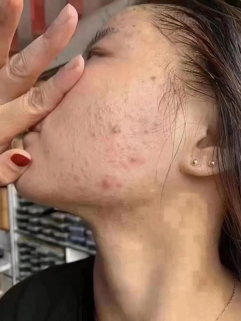 为什么长闭合性粉刺