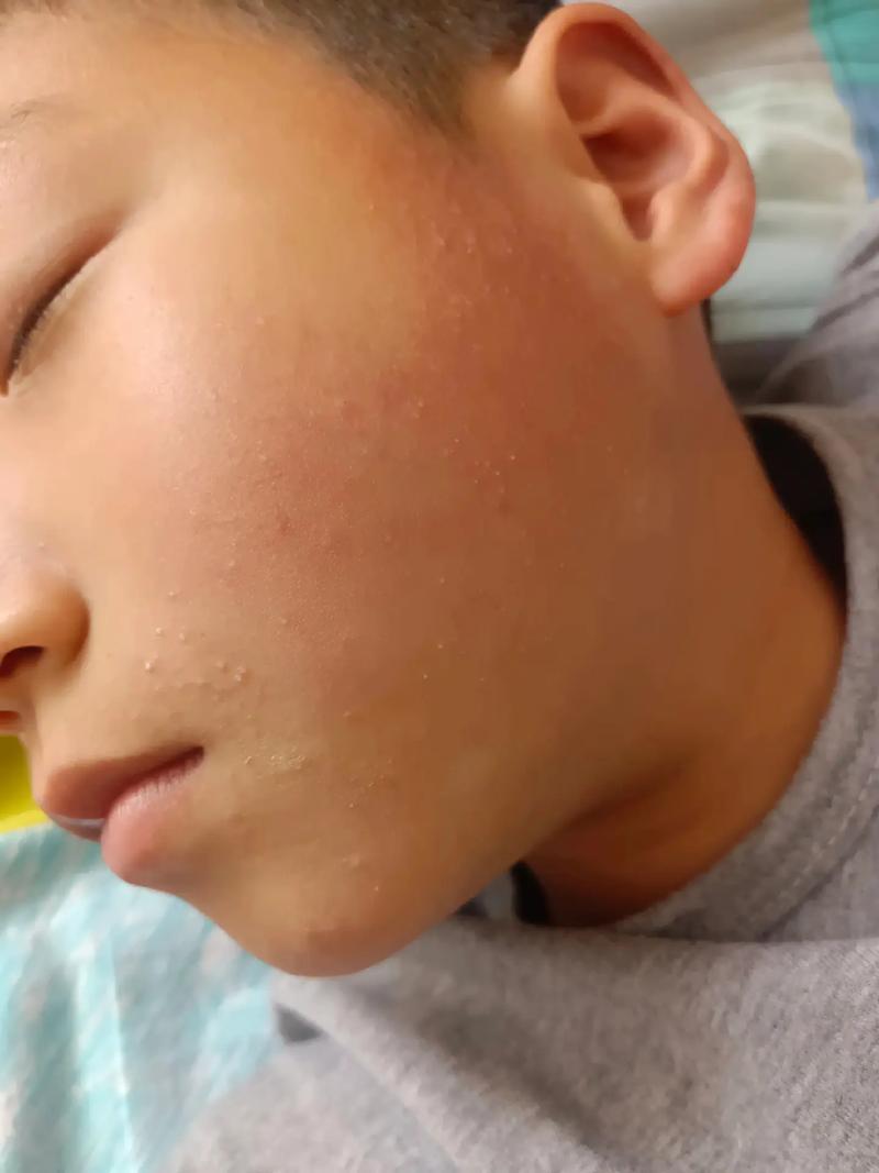 脸上为什么起小疙瘩