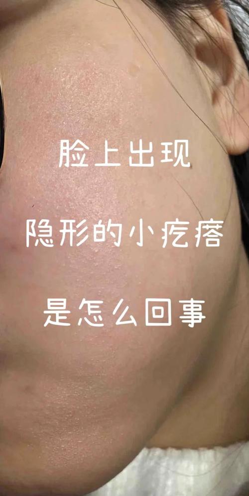 脸上为什么起小疙瘩