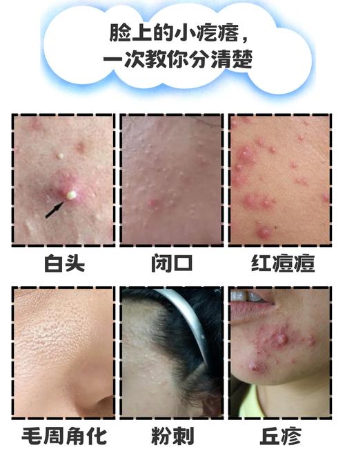 脸上为什么起小疙瘩