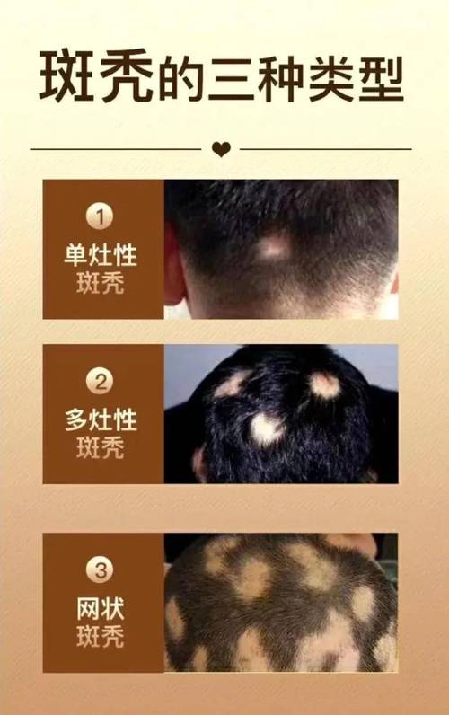 小孩斑秃是什么原因