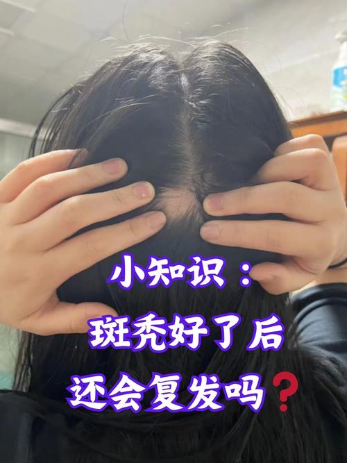 小孩斑秃是什么原因