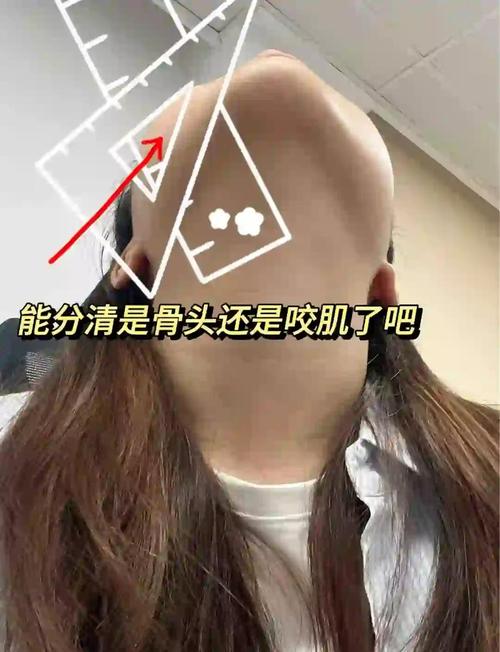 咬肌大是什么脸型