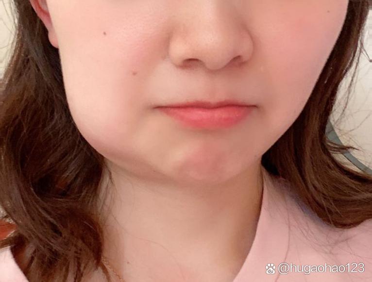 拔牙为什么会脸肿