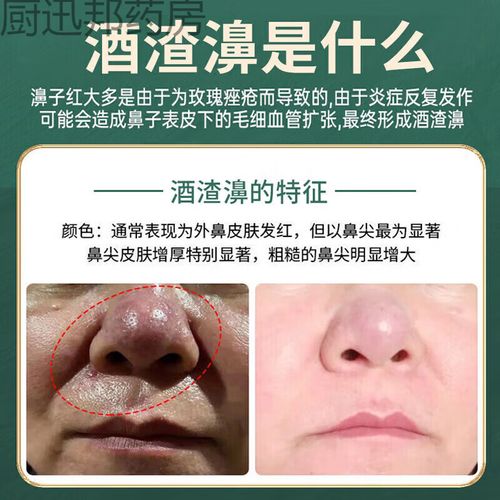 草莓鼻用什么药