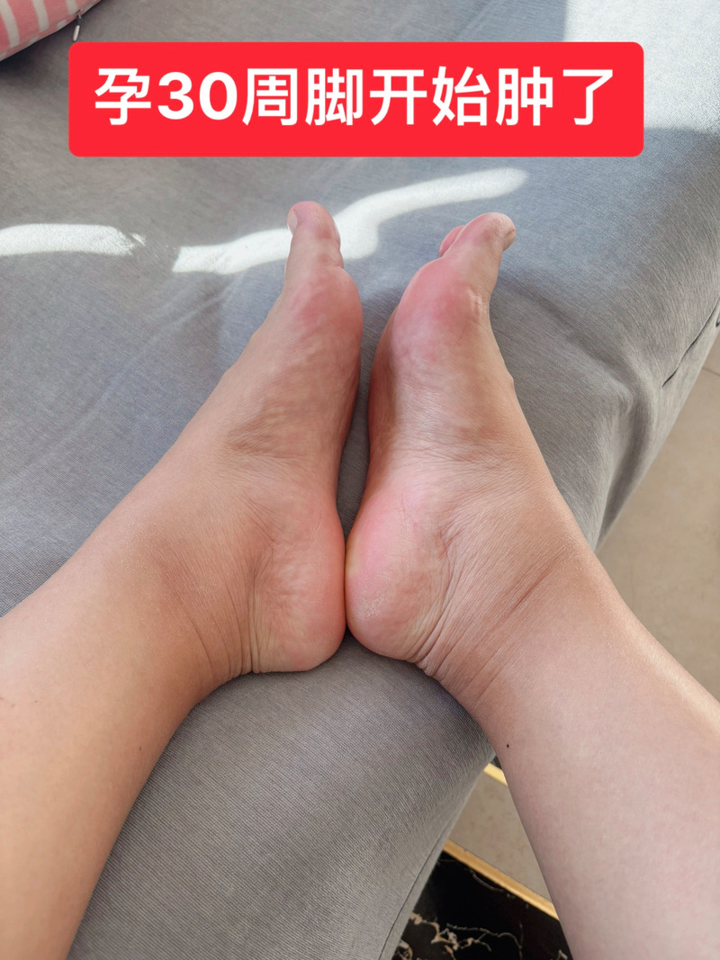 孕妇腿肿吃什么