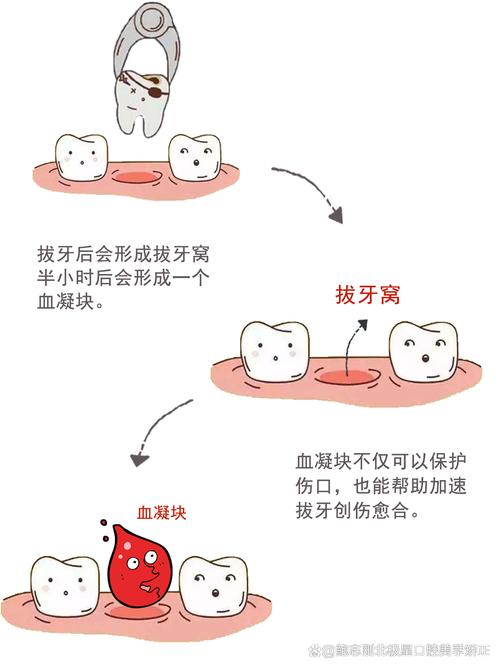 感冒为什么不能拔牙