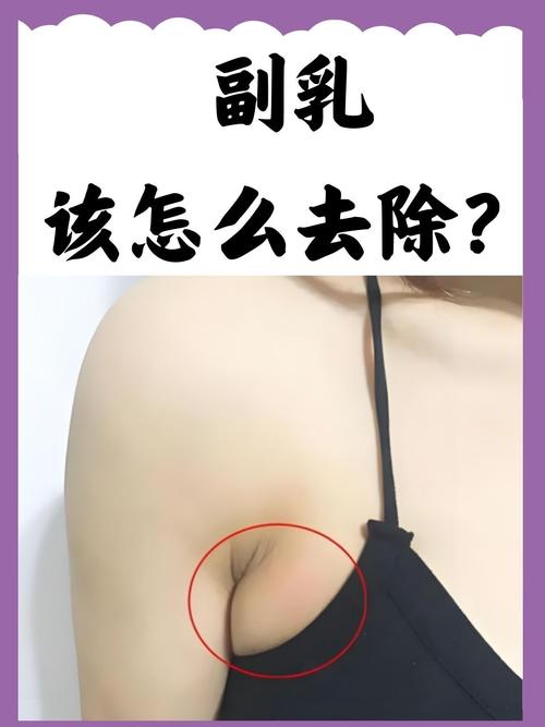 副乳是什么图片