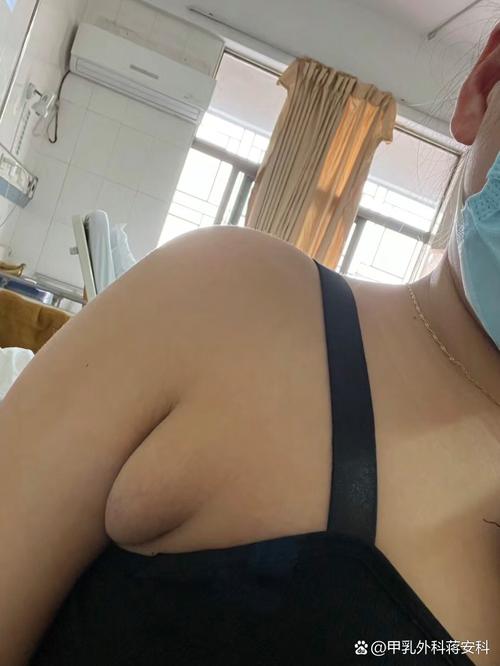 副乳是什么图片