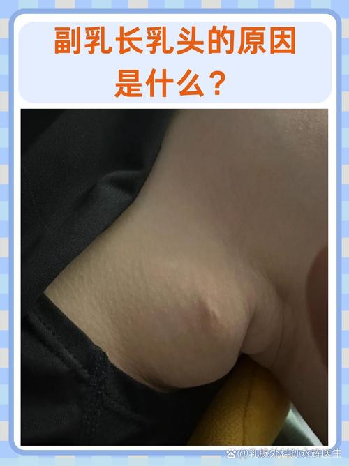副乳是什么图片